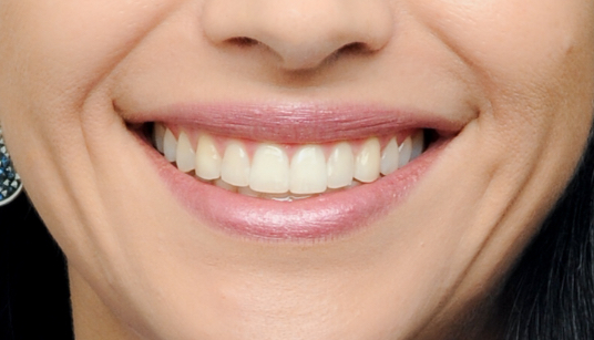 A beautiful smile is a good balance between gums and teeth.