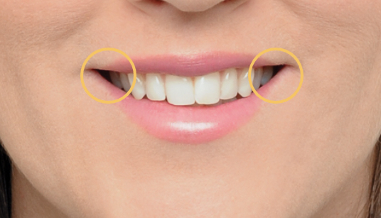 Tipped-in teeth reduce brightness with dark corners.