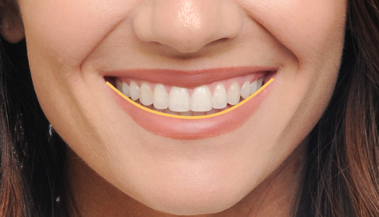 A smile arc is created when the curve of the teeth follows the lower lip.