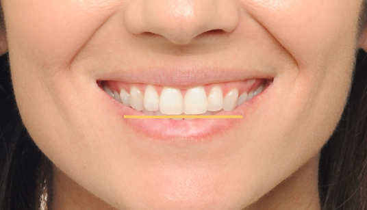 Teeth that appear at the same level create a flat smile.