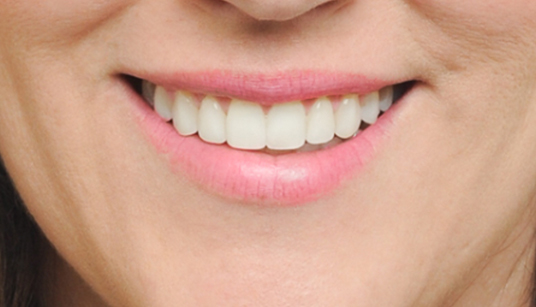 A bright, broad arch smile shows more teeth.