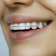 Teeth can move after treatment.